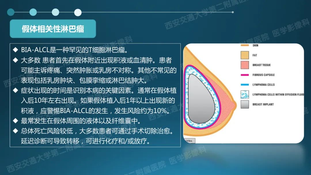 影像PPT - 【PPT】乳腺假体植入的MRI评估-30