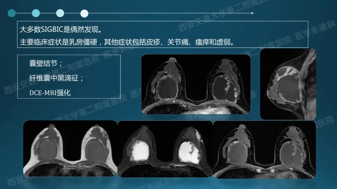 影像PPT - 【PPT】乳腺假体植入的MRI评估-29