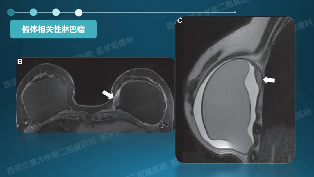 影像PPT - 【PPT】乳腺假体植入的MRI评估-31