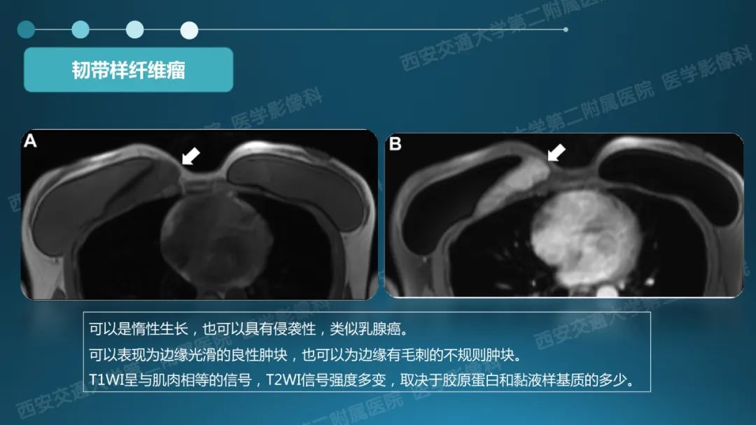 影像PPT - 【PPT】乳腺假体植入的MRI评估-32