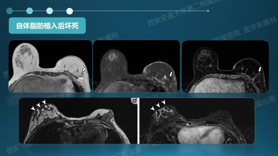 影像PPT - 【PPT】乳腺假体植入的MRI评估-33