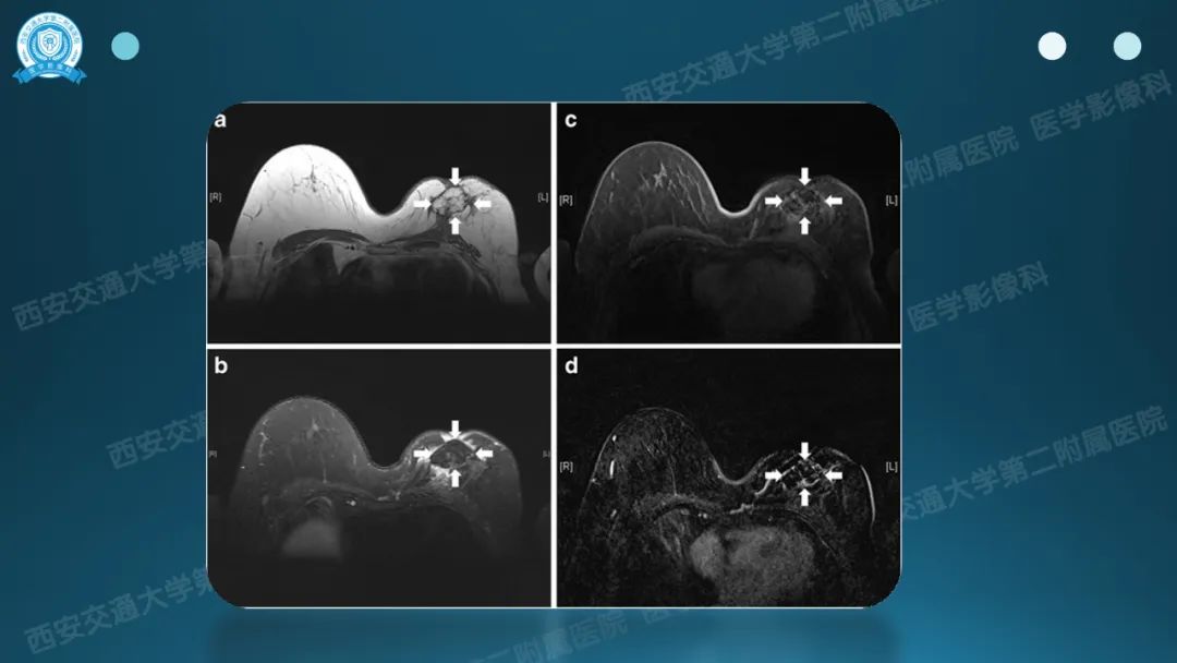 影像PPT - 【PPT】乳腺假体植入的MRI评估-34