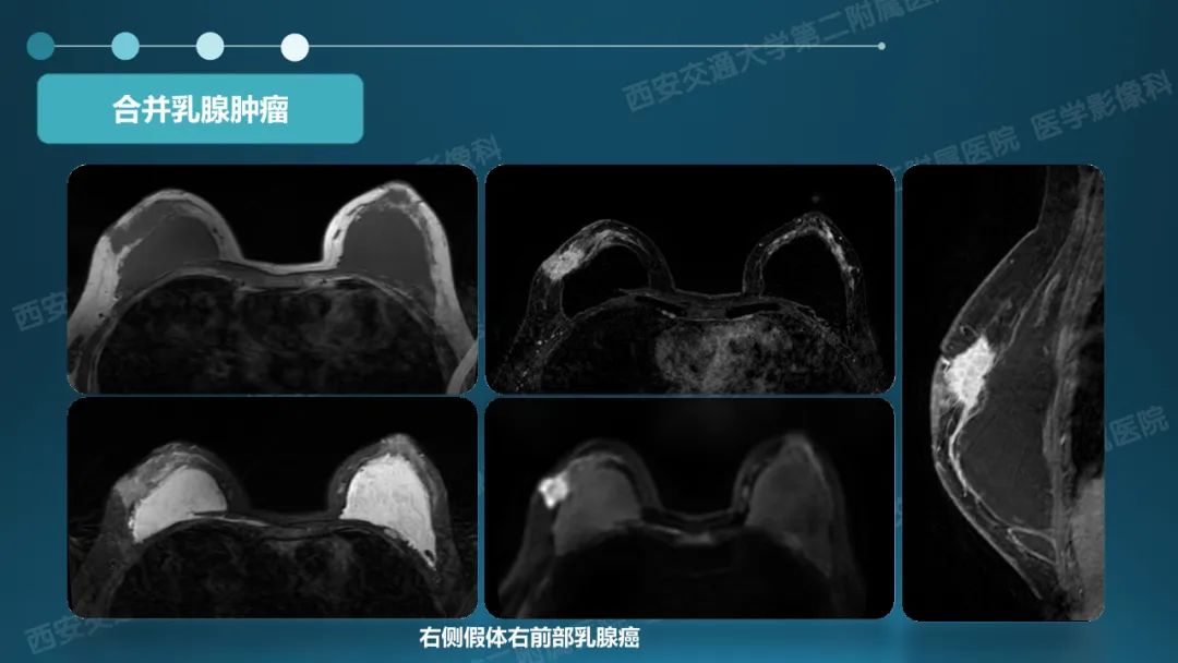 影像PPT - 【PPT】乳腺假体植入的MRI评估-35