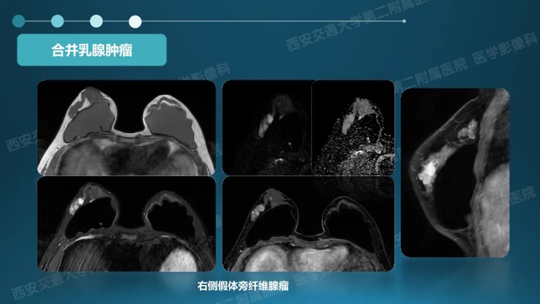 影像PPT - 【PPT】乳腺假体植入的MRI评估-36