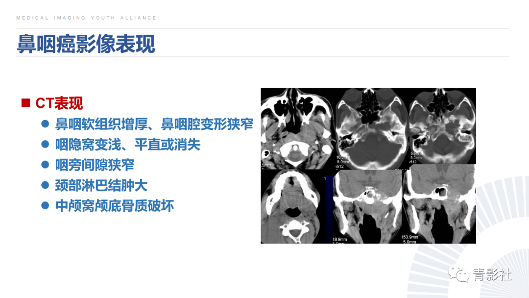 影像PPT - 【PPT】鼻咽癌周围结构侵犯的影像诊断思路-14