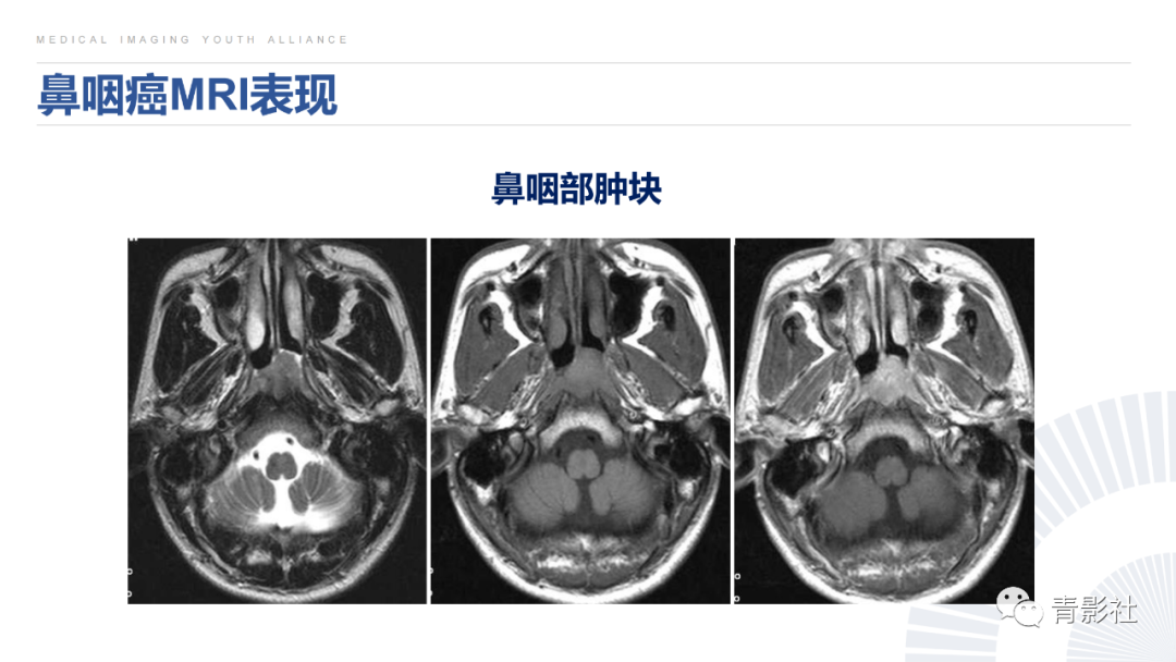 影像PPT - 【PPT】鼻咽癌周围结构侵犯的影像诊断思路-17