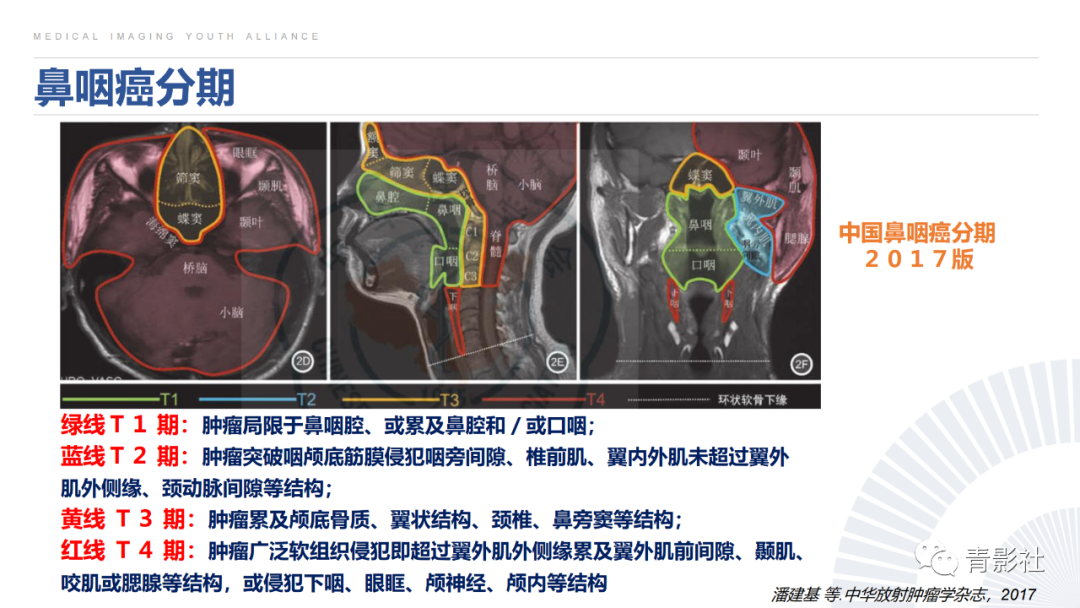 影像PPT - 【PPT】鼻咽癌周围结构侵犯的影像诊断思路-20