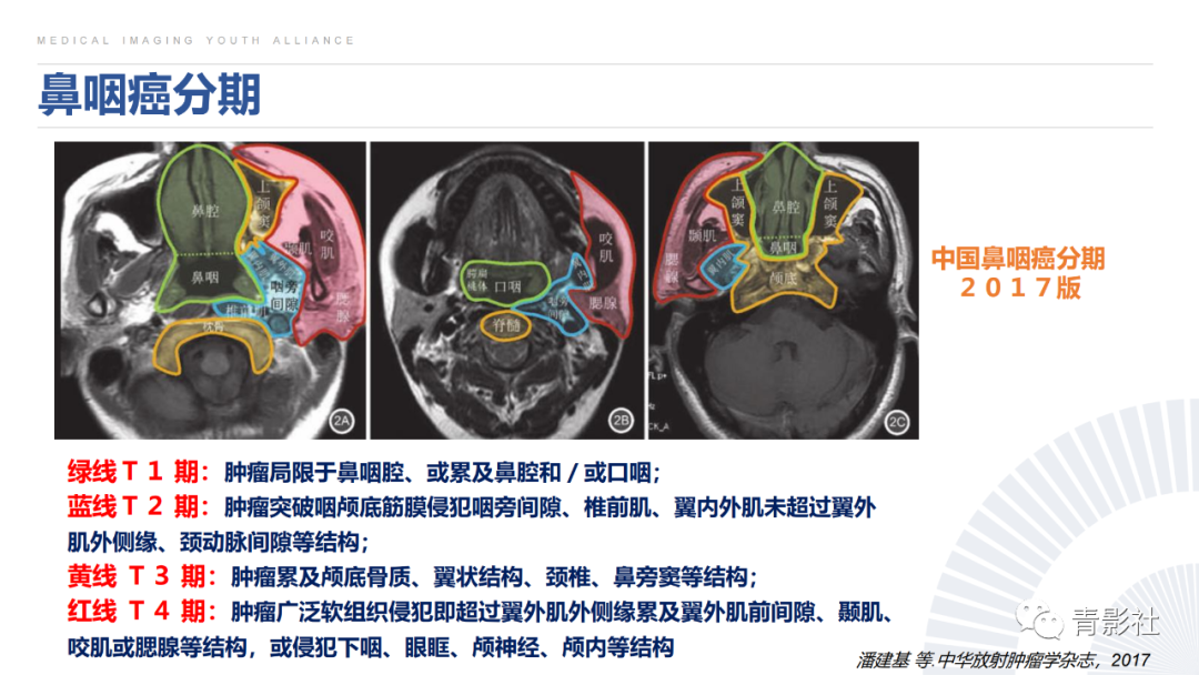 影像PPT - 【PPT】鼻咽癌周围结构侵犯的影像诊断思路-19