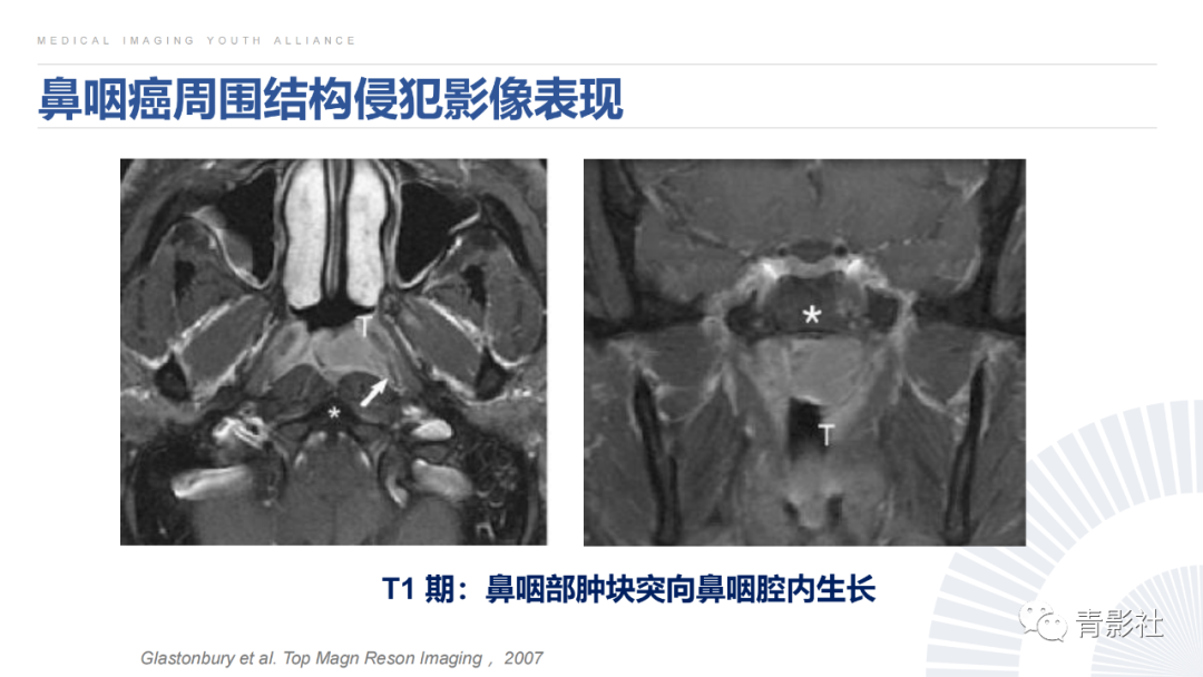 影像PPT - 【PPT】鼻咽癌周围结构侵犯的影像诊断思路-24