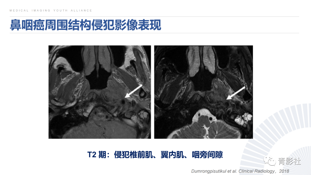 影像PPT - 【PPT】鼻咽癌周围结构侵犯的影像诊断思路-25