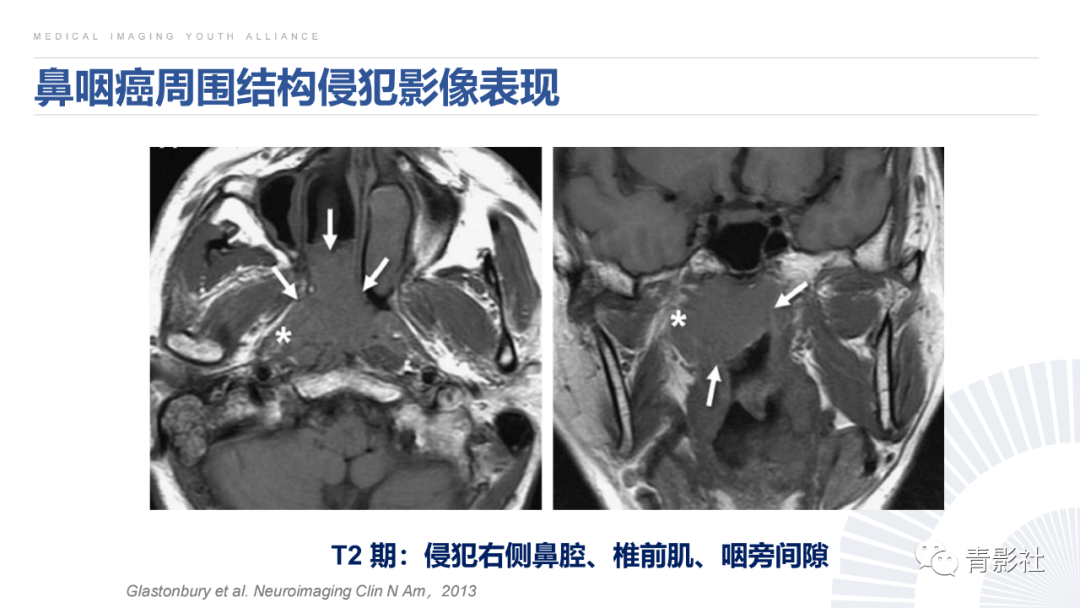 影像PPT - 【PPT】鼻咽癌周围结构侵犯的影像诊断思路-26
