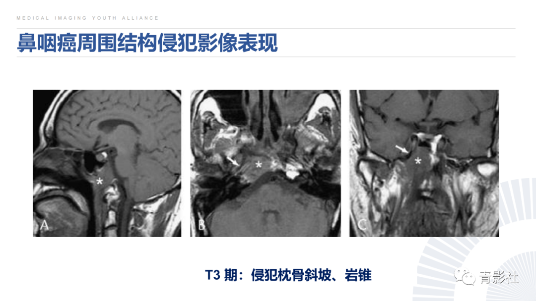 影像PPT - 【PPT】鼻咽癌周围结构侵犯的影像诊断思路-27