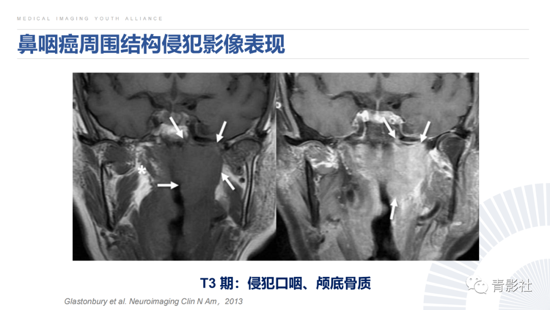 影像PPT - 【PPT】鼻咽癌周围结构侵犯的影像诊断思路-28