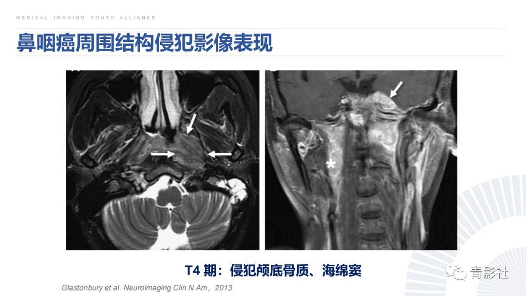 影像PPT - 【PPT】鼻咽癌周围结构侵犯的影像诊断思路-29