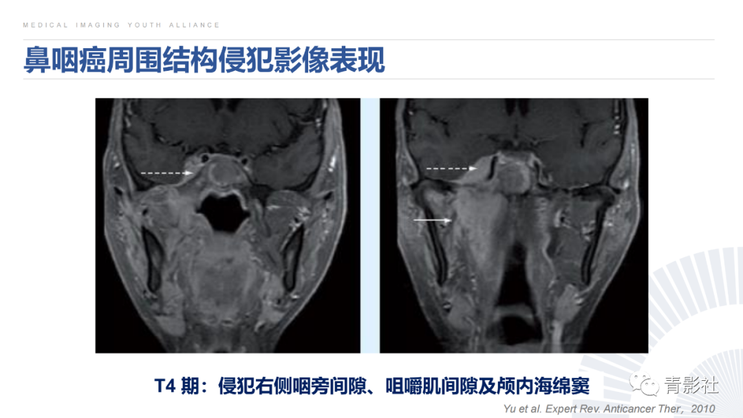 影像PPT - 【PPT】鼻咽癌周围结构侵犯的影像诊断思路-30