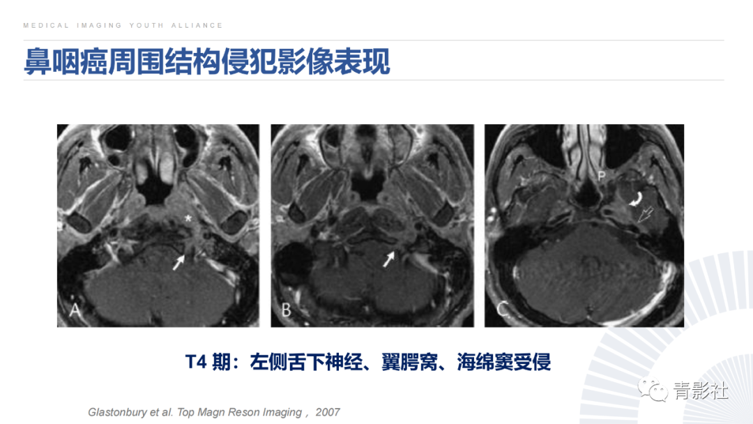 影像PPT - 【PPT】鼻咽癌周围结构侵犯的影像诊断思路-31