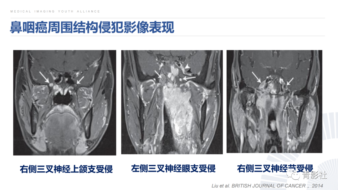 影像PPT - 【PPT】鼻咽癌周围结构侵犯的影像诊断思路-32