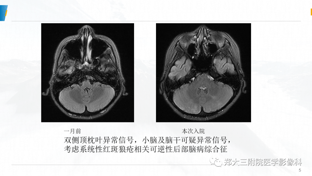 影像PPT - 【PPT】系统性红斑狼疮相关可逆性后部脑病综合征-5