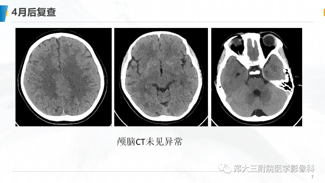 影像PPT - 【PPT】系统性红斑狼疮相关可逆性后部脑病综合征-7