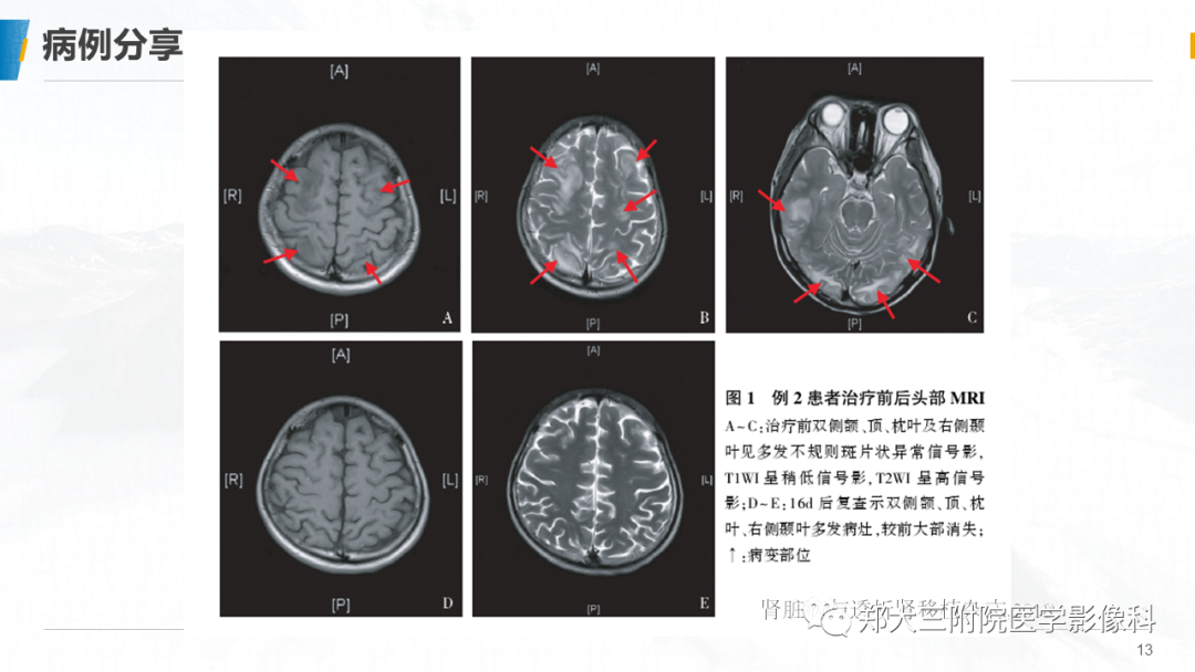 影像PPT - 【PPT】系统性红斑狼疮相关可逆性后部脑病综合征-13