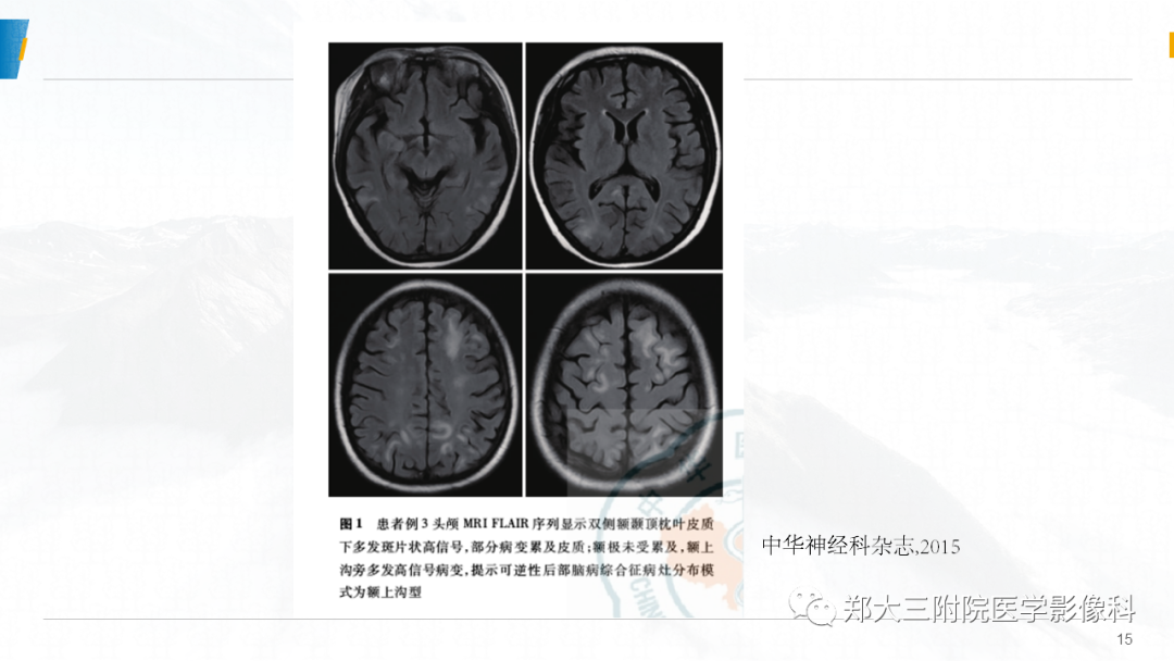 影像PPT - 【PPT】系统性红斑狼疮相关可逆性后部脑病综合征-15