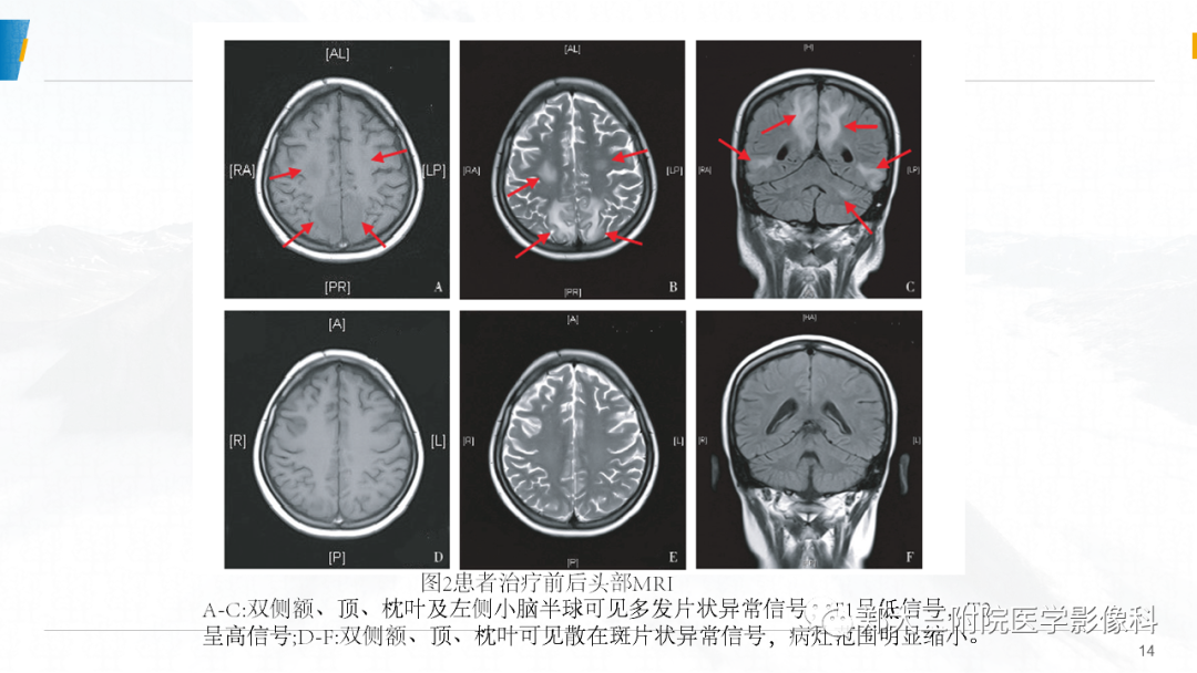 影像PPT - 【PPT】系统性红斑狼疮相关可逆性后部脑病综合征-14