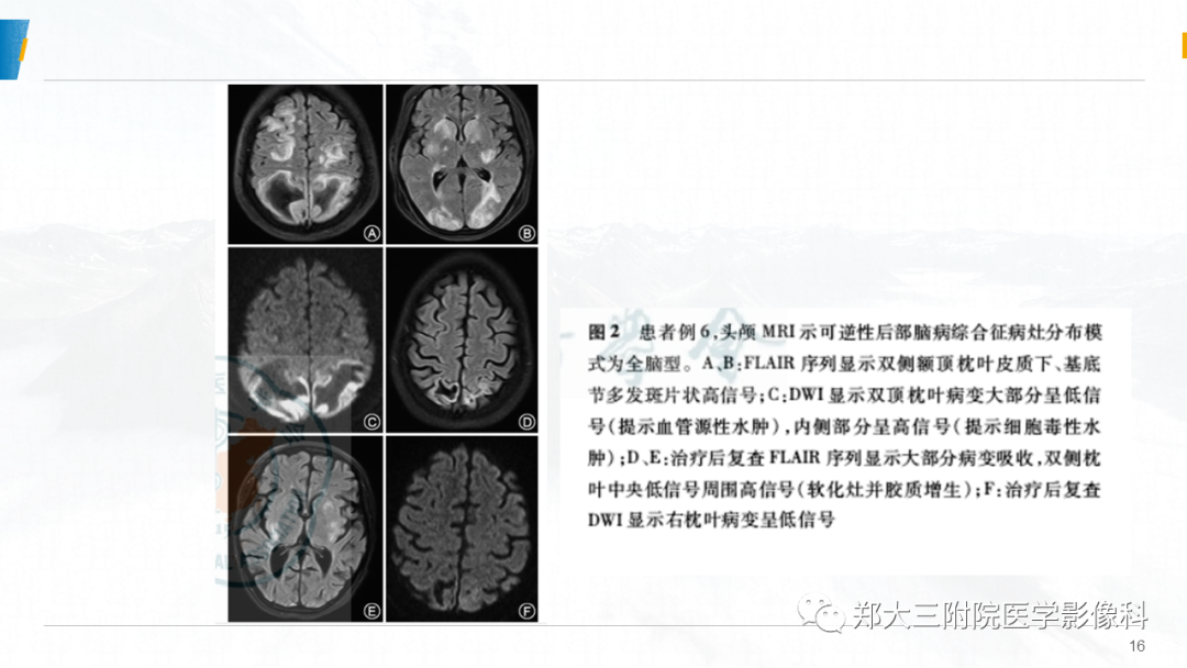 影像PPT - 【PPT】系统性红斑狼疮相关可逆性后部脑病综合征-16