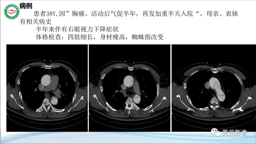 影像PPT - 【PPT】马方综合征-2