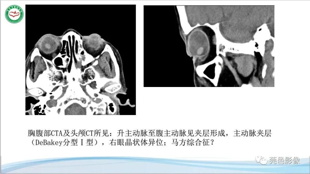 影像PPT - 【PPT】马方综合征-4