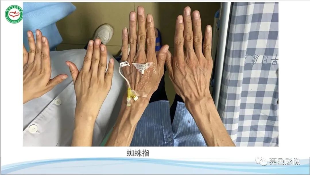 影像PPT - 【PPT】马方综合征-5