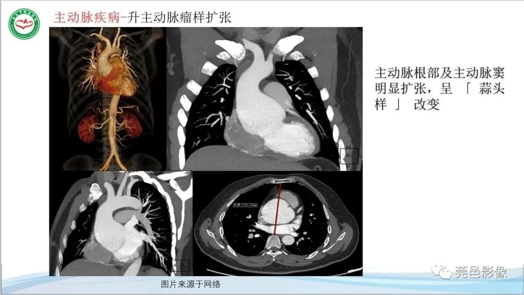 影像PPT - 【PPT】马方综合征-9