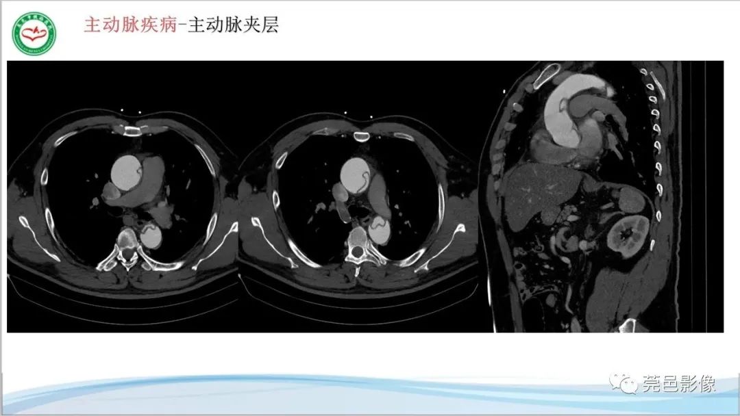 影像PPT - 【PPT】马方综合征-10
