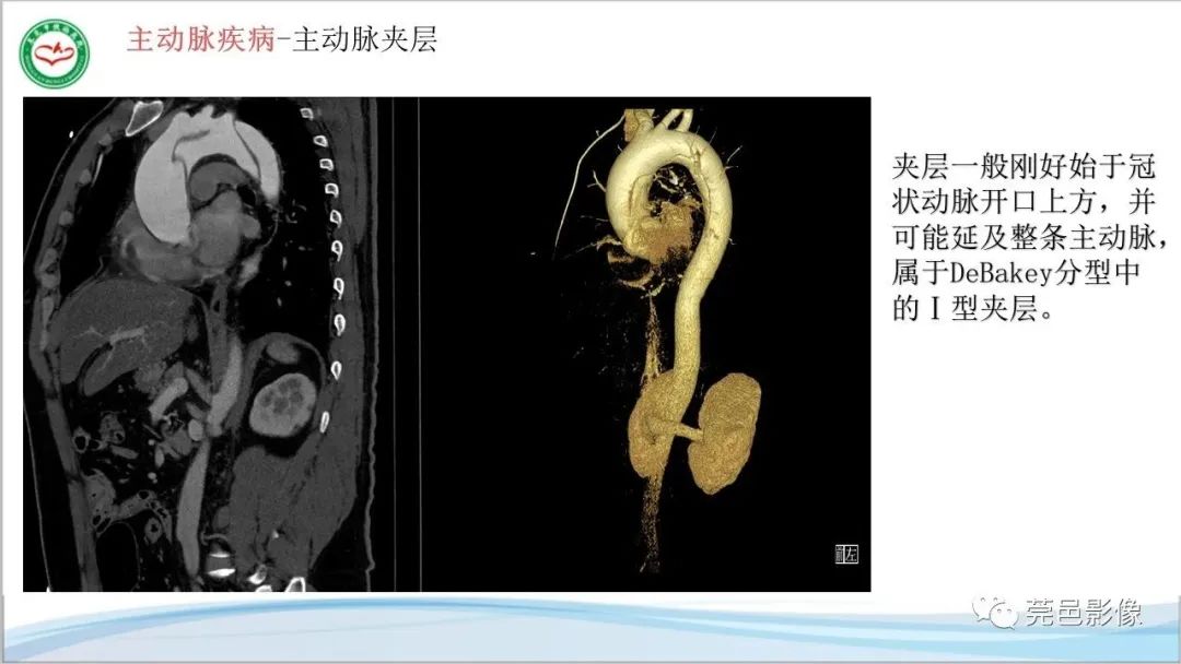 影像PPT - 【PPT】马方综合征-11