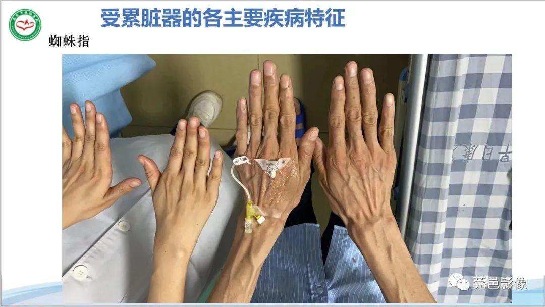 影像PPT - 【PPT】马方综合征-14