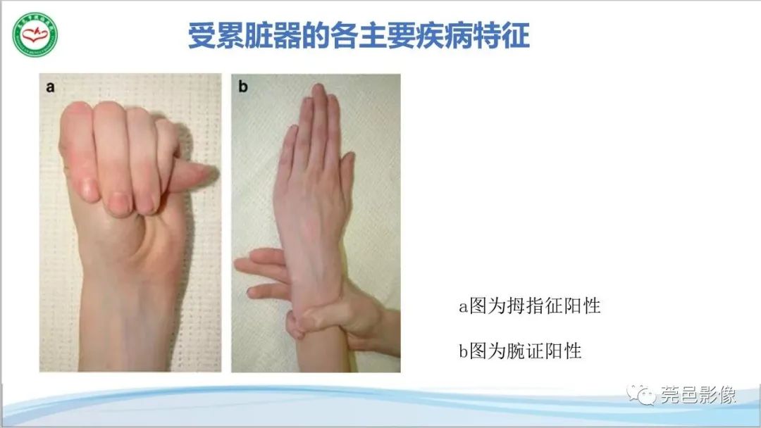 影像PPT - 【PPT】马方综合征-15