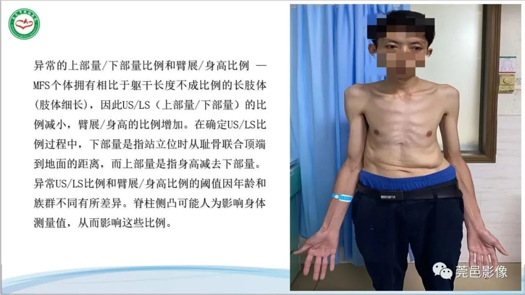 影像PPT - 【PPT】马方综合征-16