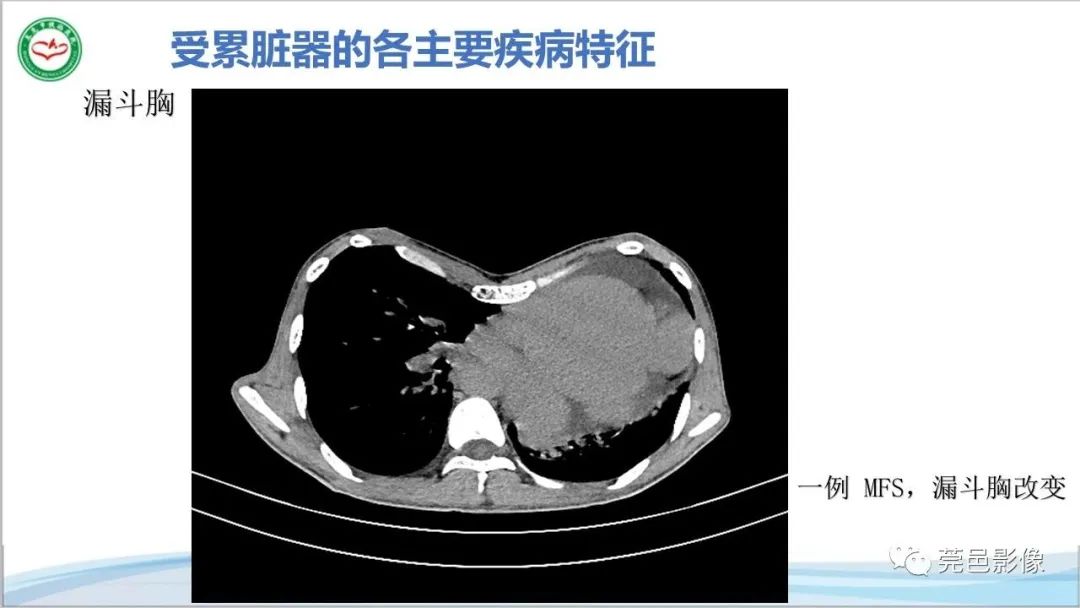 影像PPT - 【PPT】马方综合征-18
