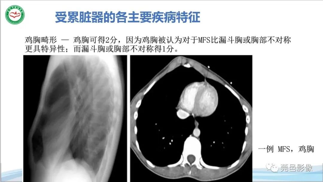 影像PPT - 【PPT】马方综合征-17