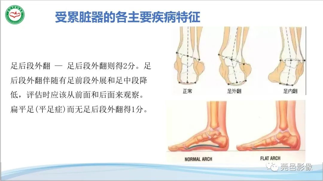 影像PPT - 【PPT】马方综合征-19