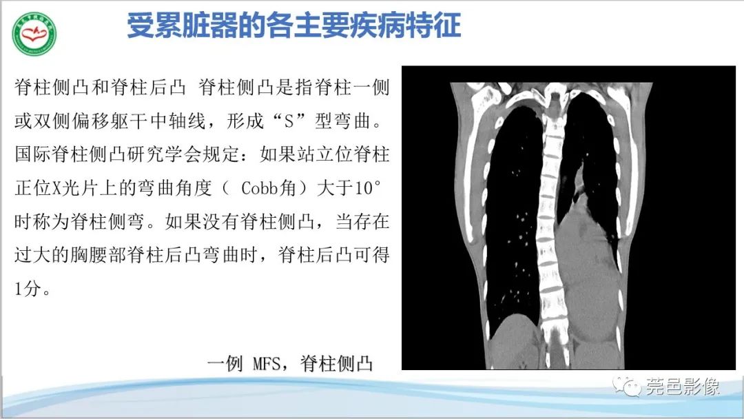 影像PPT - 【PPT】马方综合征-20