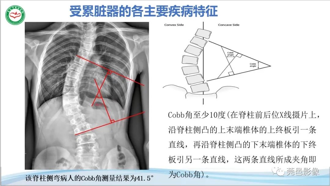 影像PPT - 【PPT】马方综合征-21