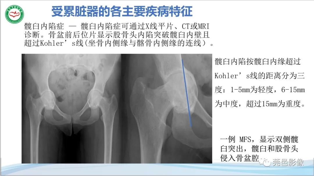 影像PPT - 【PPT】马方综合征-22