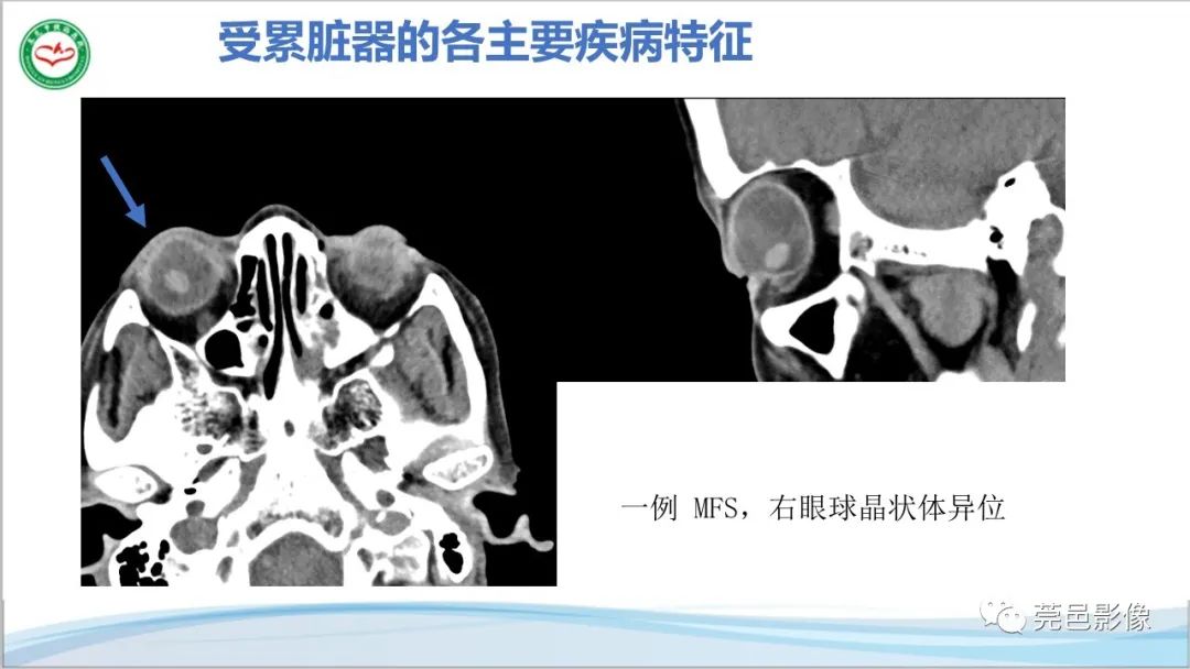 影像PPT - 【PPT】马方综合征-24