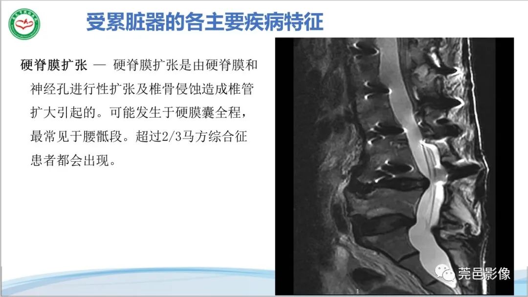 影像PPT - 【PPT】马方综合征-25
