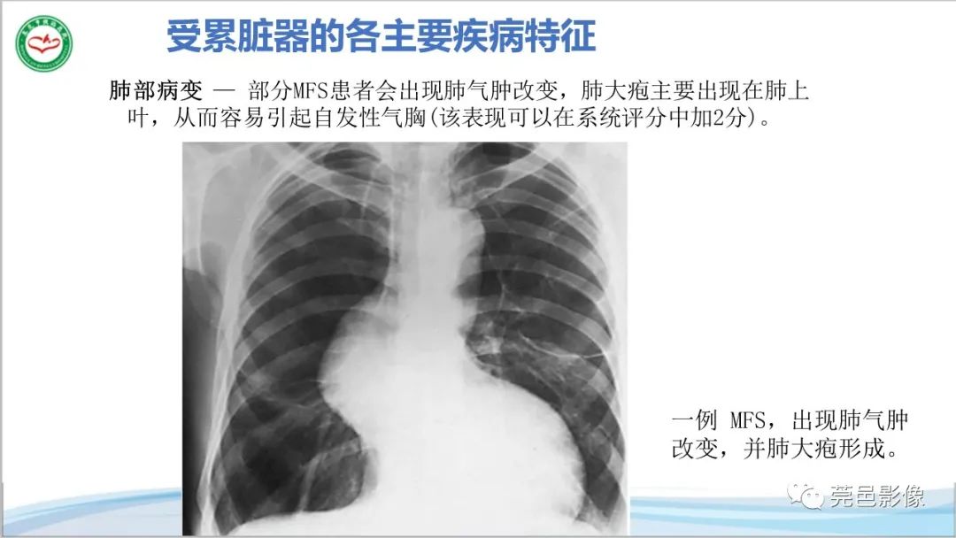 影像PPT - 【PPT】马方综合征-26