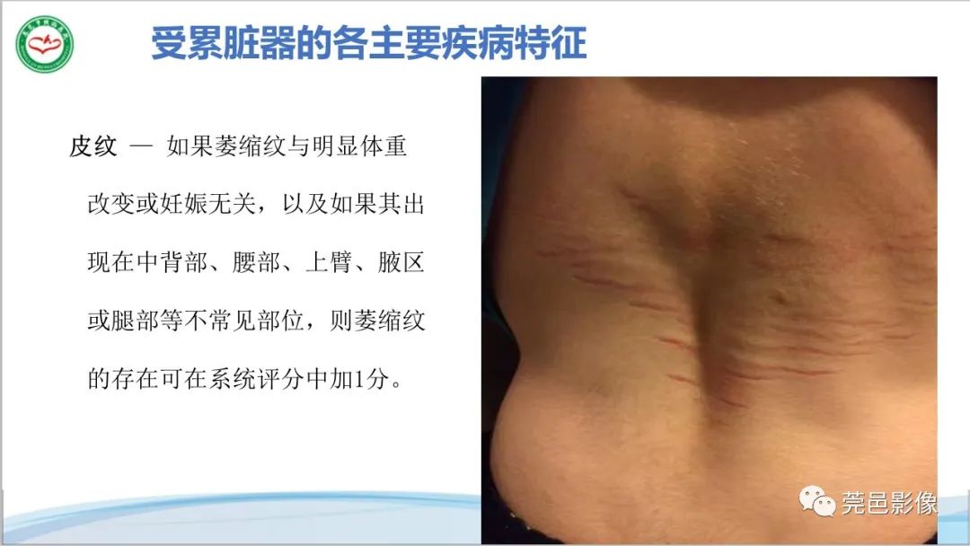 影像PPT - 【PPT】马方综合征-27