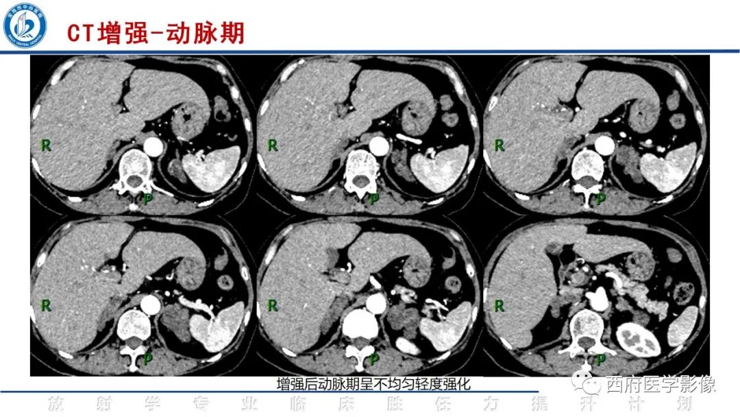 影像PPT - 【PPT】肾上腺大结节样增生影像诊断-4