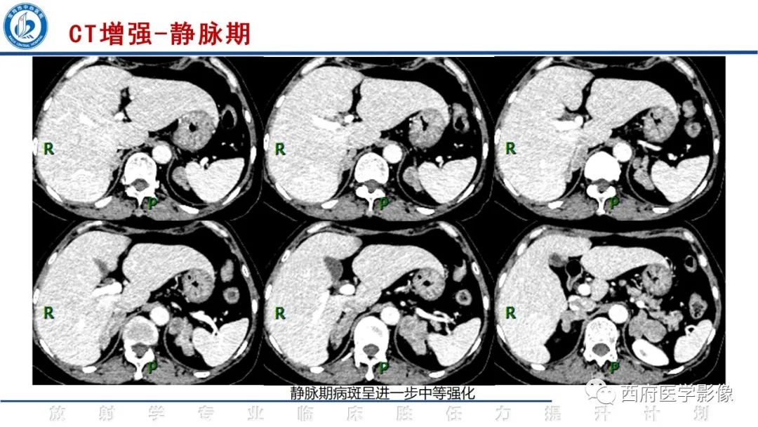 影像PPT - 【PPT】肾上腺大结节样增生影像诊断-5