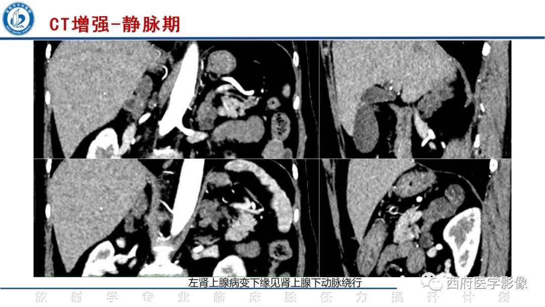 影像PPT - 【PPT】肾上腺大结节样增生影像诊断-6