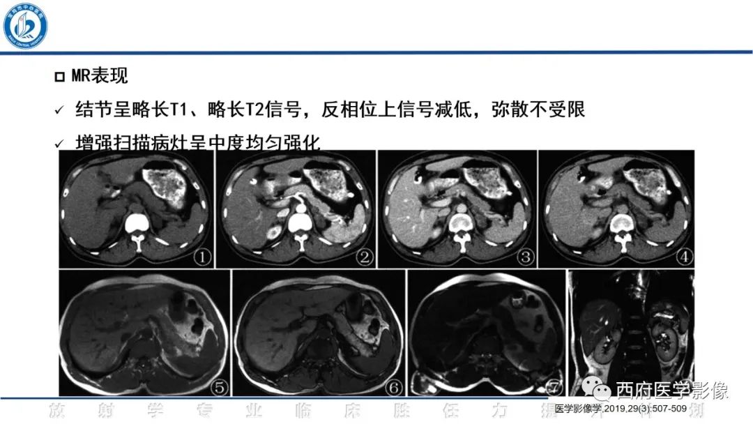 影像PPT - 【PPT】肾上腺大结节样增生影像诊断-17